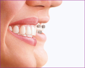 invisalign-profile