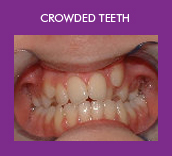 crowded teeth