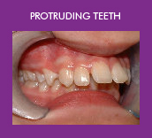 protruding teeth