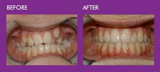 braces fix crowded teeth
